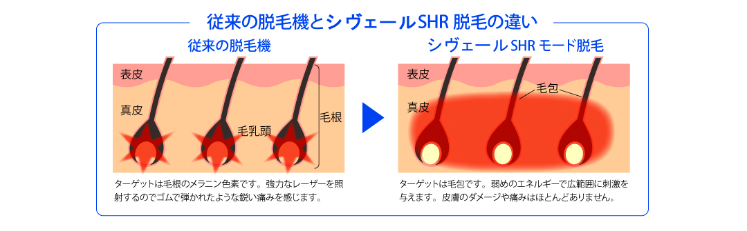 脱毛専門店 ｓｉ ｂｅｌｌe！（シヴェール） ＳＨＲ脱毛の違い